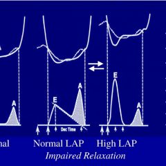 Echocardiographic Assessment of LV Diastolic Function Webinar 