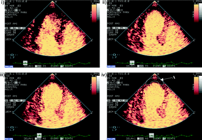 Study Demonstrates Strain Imaging Utility With Contrast-Echo Studies