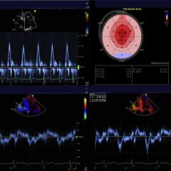 Regional left ventricular systolic dysfunction associated with critical  illness: incidence and effect on outcome - Cavefors - 2021 - ESC Heart  Failure - Wiley Online Library