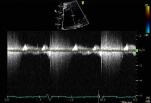 CWDoppler of MR