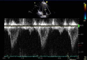 PulsedDoppler LVOT