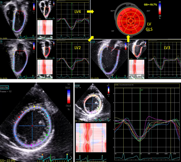 Two-dimensional strain echocardiography