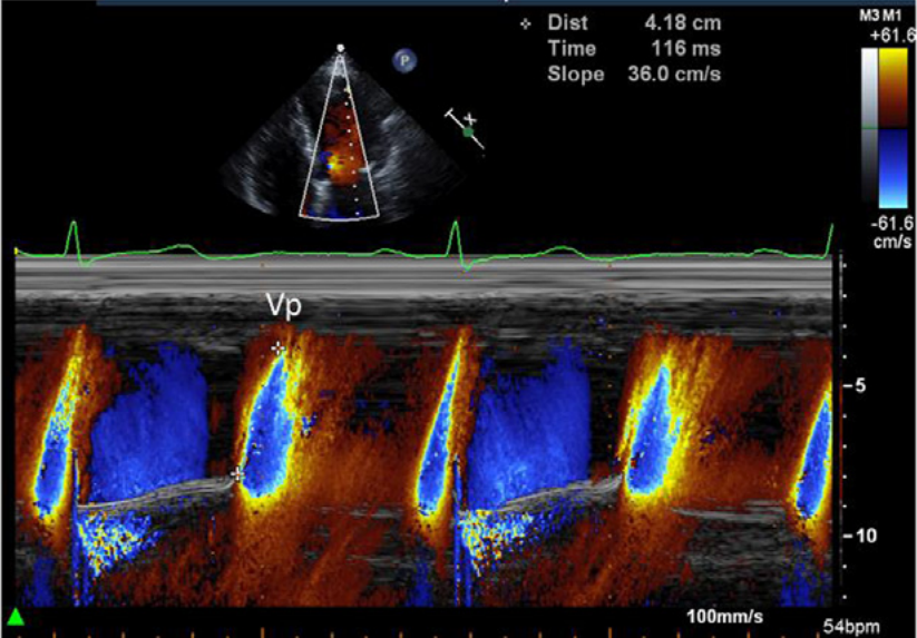 Evaluation of Left Ventricular Diastolic Function by Echocardiography and for Heart Failure With Preserved Ejection Fraction Diagnosis!"