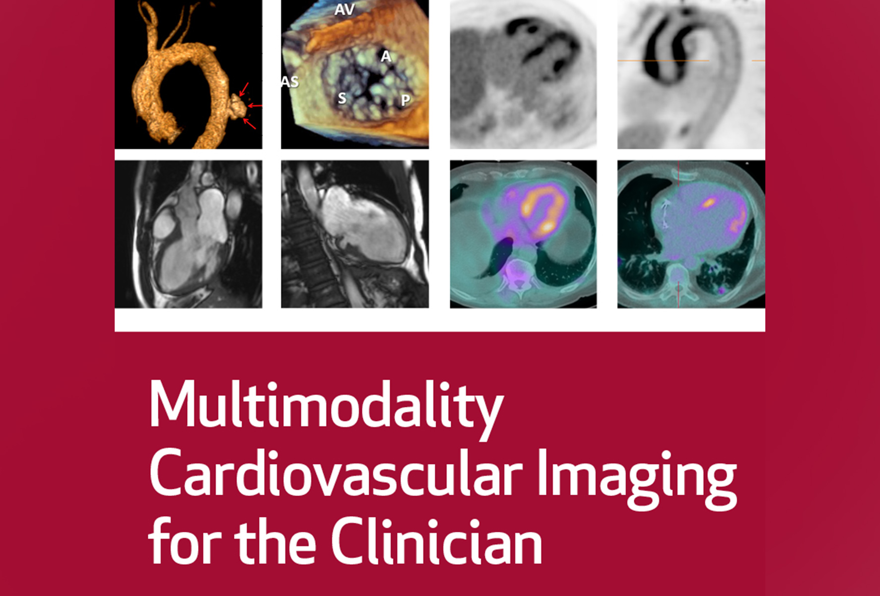 Cardiovascular imaging plays a vital role in the management of the cardiovascular patient. Knowledge of various imaging modalities is critical to understanding their advantages, limitations and appropriate utilization in patients with ischemic heart disease, heart failure, atrial fibrillation, cardiomyopathy, masses, valvular disease, and aortic disease. This conference offers didactic lectures, case discussions and Q&A by world experts in each imaging modality. Demonstrations of heart anatomy assist in visualizing and understanding cardiac and valvular structure to enhance correlations with cardiac imaging.