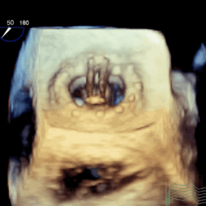 3D enface of normal mechanical MV