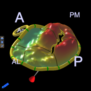 3D model of gigantic bileaflet prolapse