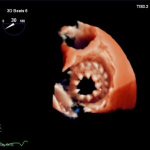 3d enface true view of Evoque valve in tricuspid position