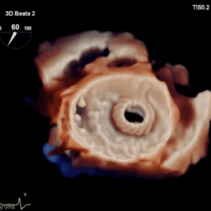 Alta Valve true view