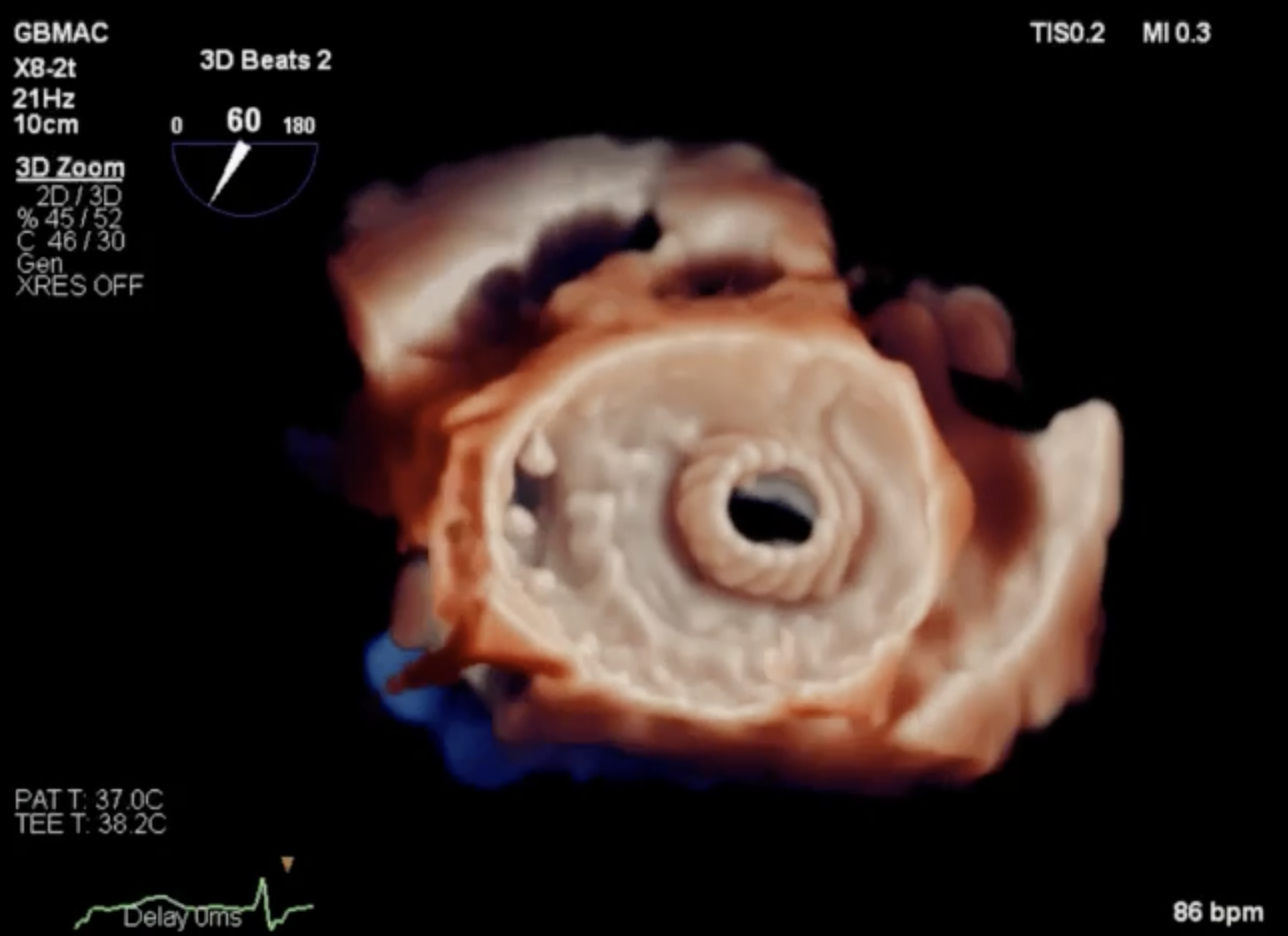 Alta Valve true view