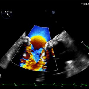 Great example of PISA in TMVR