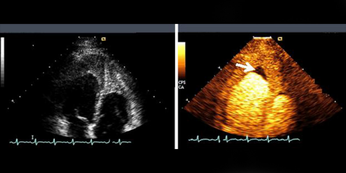 Noncontrast (left) and real-time very low MI contrast-enhanced (right) images of a patient with an apical mass in whom realtime very low MI imaging delineates both perfusion and nonperfusion due to endomyocardial fibrosis with thrombus formation