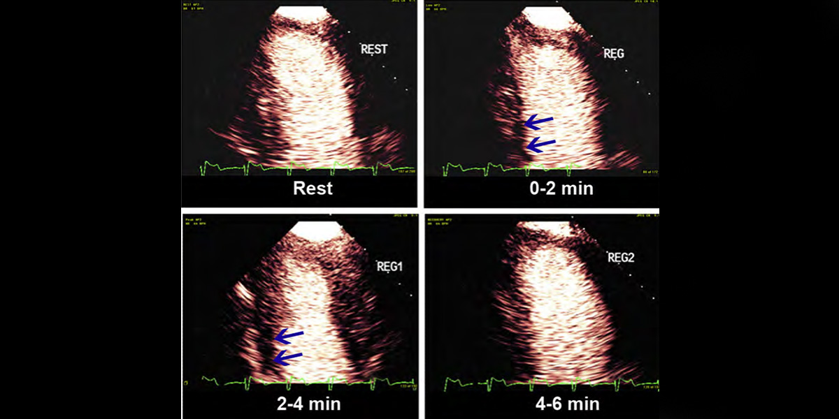 Clinical Applications of Ultrasonic Enhancing Agents in Echocardiography